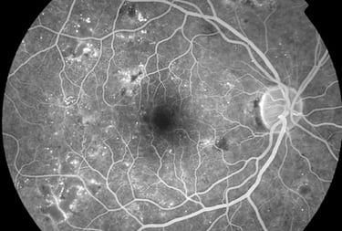 non prolific diabetic retinopathy