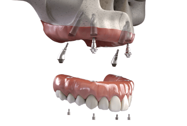 a dental implanting model of a teeth