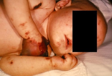 horrid meningococcal disease