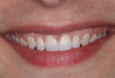 a close up of a person's teeth after invisalign aligner treatment