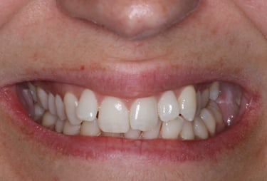 a close up of a person's mouth with mis aligned teeth