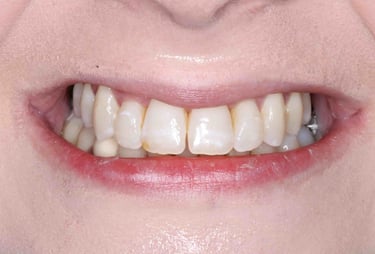 a close up of a person's teeth after invisalign aligner treatment