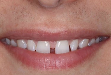 a close up of a person's mouth with mis aligned teeth