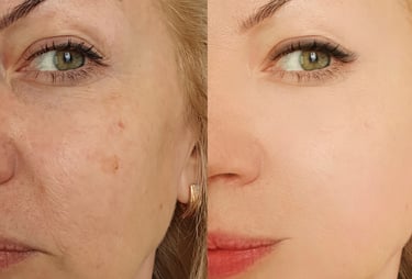 Botox Before and After