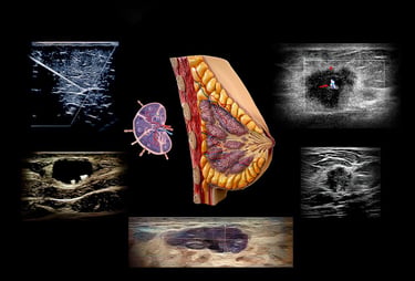 Montage of breast ultrasound images showing normal findings, breast cancer, and breast biopsy technique.
