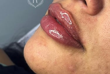 preenchimento facial com ácido hialurônico - Dra. Raphaela Dafne Tatuapé