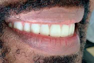 All on 4 final fixed zirconia bridges