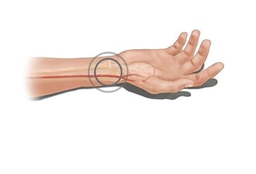 vascular ultrasound coronary artery bypass graft mapping radial surgery heart arm scan imaging perth blocked cabg chest pain