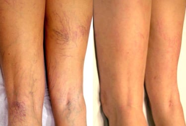 Tratamiento Varices, Antes y después, Cambrils, Tarragona, Instituto Médico Vilafortuny,