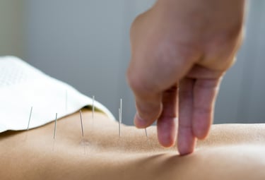 Une séance d'acupuncture, sur le dos