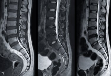 Magnetkamerabilder (MR) av ryggraden som visar olika sekvenser för diagnostik.