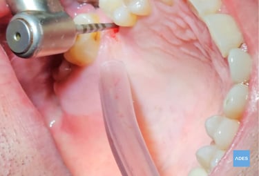 Implantología dental en Badajoz