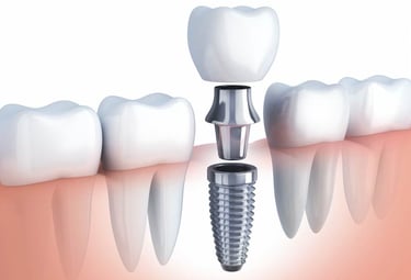 best dental implants in baner