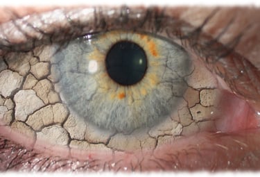 Tratamiento del Síndrome de Ojo Seco en Guayaquil