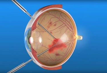 Tratamiento y Diagnóstico de Enfermedades de la Retina en Guayaquil