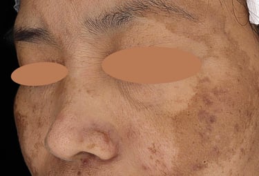 melasma hyperpigmentation singapore
