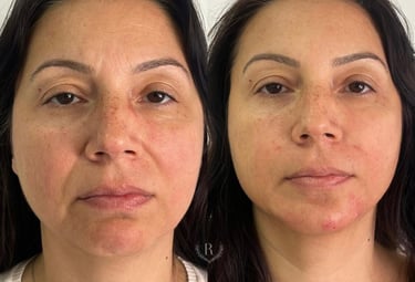 fios de pdo lifting facial sem cirurgia - Tatuapé