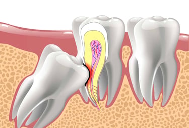 wisdom tooth removal by top oral surgeon in Evershine nagar Malad west in Mumbai