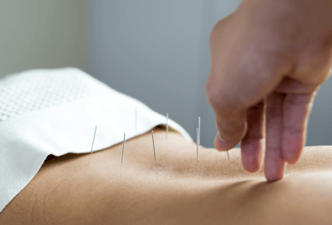 Une séance d'acupuncture, sur le dos