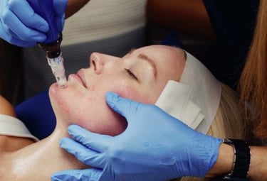 Microneedling treatment fine lines skin rejuvenation performed by a doctor