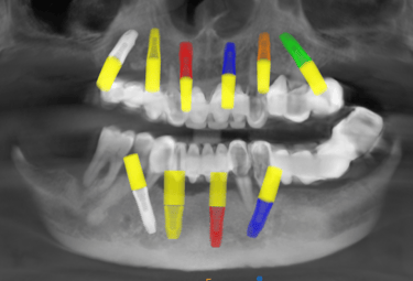 advance implantology in nagpur