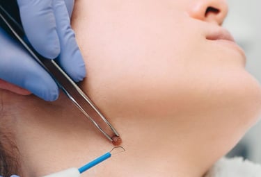 Eliminacion verrugas con tecnologia laser