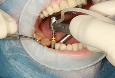 Implantes dentales en Santo Domingo