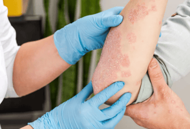 Eczema & Psoriasis Treatment