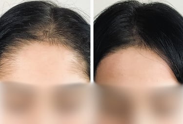 Tricopigmentation Avant Après Calvitie Perte de Densité Capillaire Femme