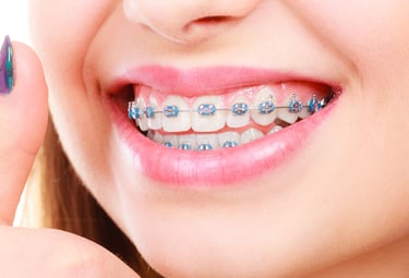 Una sonrisa que muestra brackets dentales para tratamiento de ortodoncia y dientes alineados.