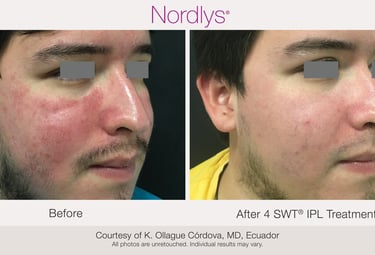 before and after redness and vascular treatment results in Hamilton clinic