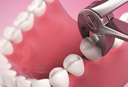 a dental model with extraction of a tooth