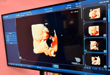 A medical monitor displaying a 3D ultrasound scan of a fetus showing facial features during a prenatal checkup.