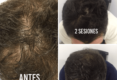 Mesoterapia para la caida del cabello 