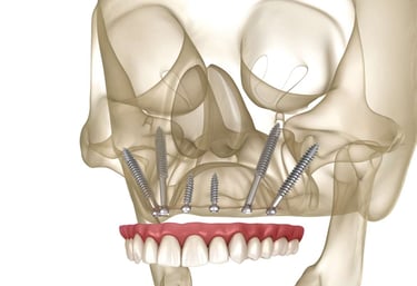 implantes cigomaticos