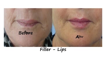 Before and after lip fillers in Delhi. Lips gain volume & contour, reduced lines, natural look.