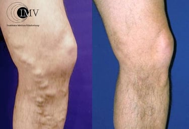 Dilataciones Varicosas, Antes y después, Varices, Cambrils, Tarragona, Instituto Médico Vilafortuny,