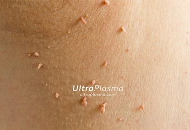 ultraplasma.com_skin_tag_removal_treatment_et_beni_temizleme_silme_tedavi_ultra_plasma_ultra_plazma2