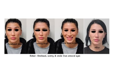Före- & efterbild botox övre ansikte – fräschare, mer tilltalande och piggare utseende.