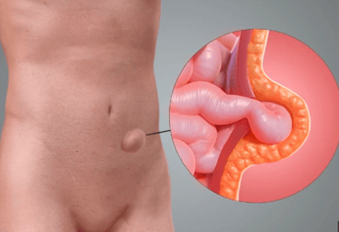 Imagem ilustrativa Hérnia de Spiegel