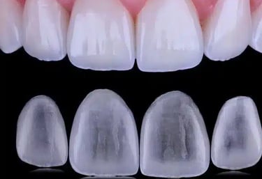 Facetas de porcelana em Curitiba para um sorriso branco e harmonioso.