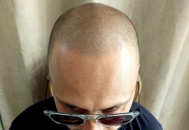 homme atteint de calvitie totale