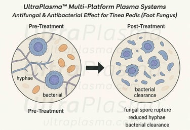 ultra_plasma_ultra_plazma_ultra-plasma_ultra-plazma_foot_fungus_ayak_mantari_tinea_pedis