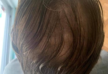 homme qui a une perte de densité capillaire