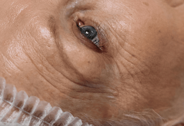 Blefaroplastia