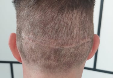 chomme qui a une cicatrice sur le cuir chevelu à cause d'une greffe capillaire