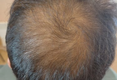 homme avec une calvitie partielle