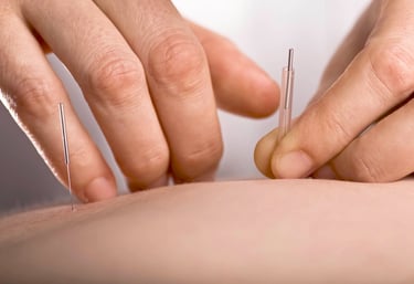 Acupuncture