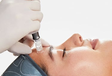Microneedling procedure for anti-aging results
