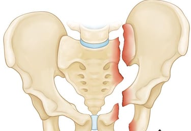 Dr.Rajinikanth's ortho clinic pelvic fractures